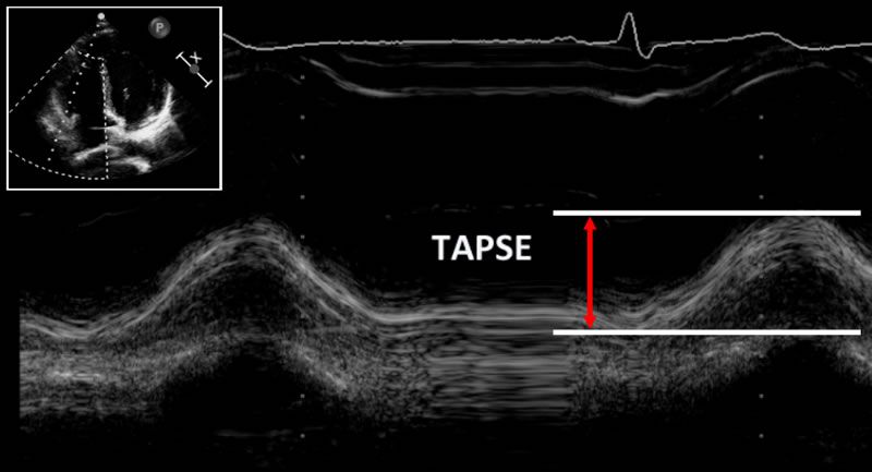 TAPSE on Echocardiogram Tricuspid annular plane systolic excursion