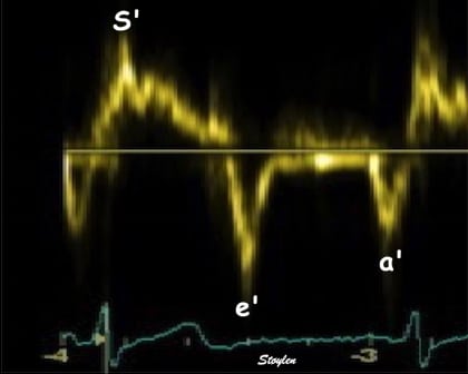 Tissue Doppler Imaging (TDI)